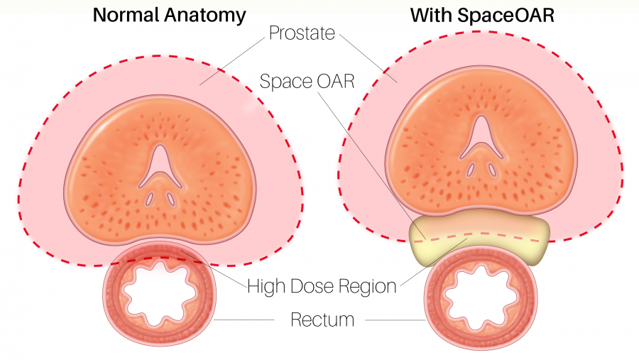 SpaceOAR Hydrogel