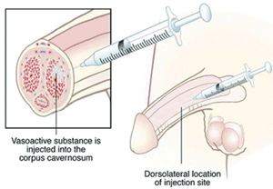 Penile Injections